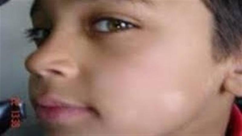 ما اسباب البقع البيضاء على الوجه؟